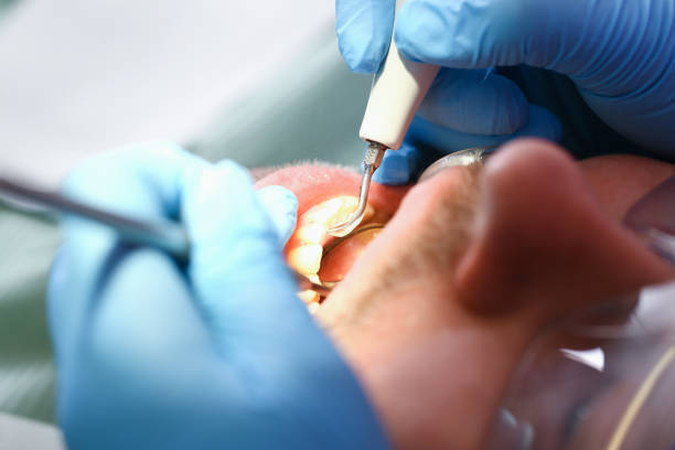 Best Broken or Cracked Tooth Emergency Dentist in Brent, AL
